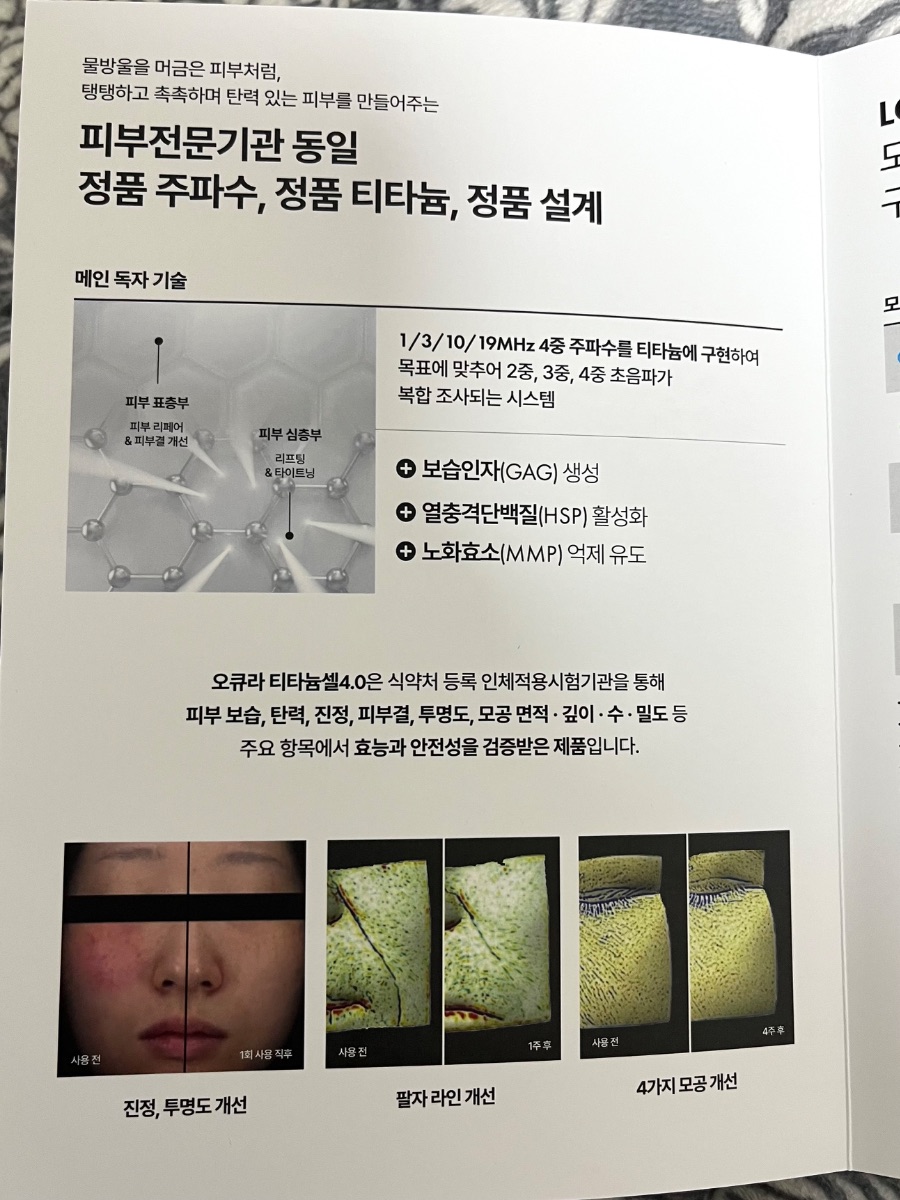 우당탕탕 여드름 일기, 그리고 오큐라 티타늄셀